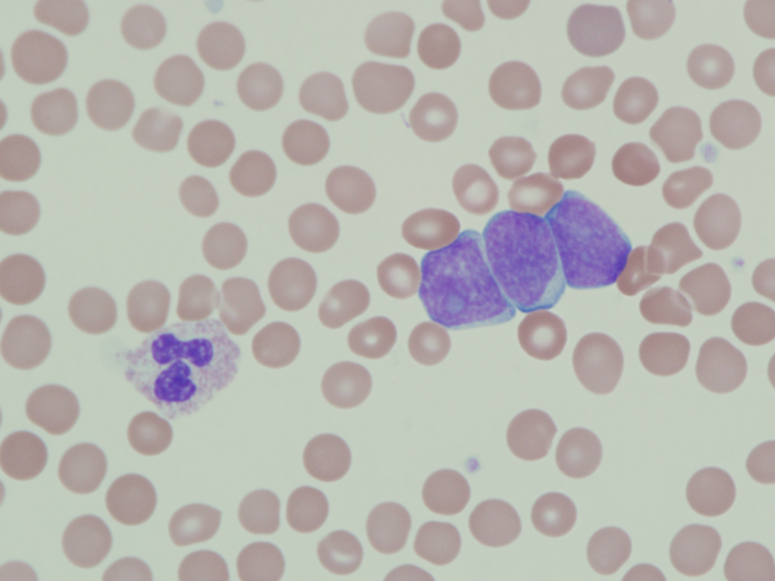 Figure 1b: Peripheral blood smear highlighting blast morphology (1000x magnification).
